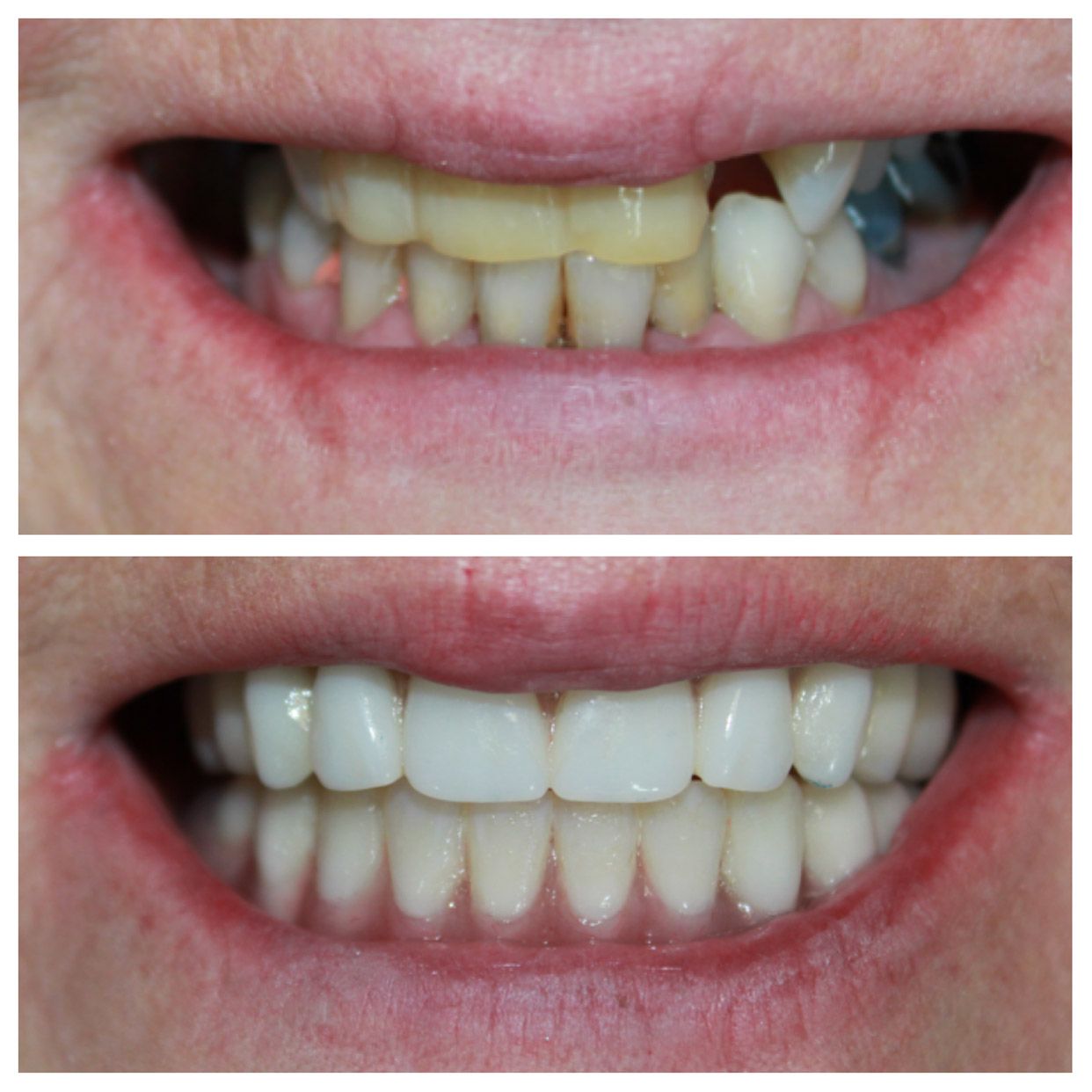 Before and after of patient with stained and missing teeth